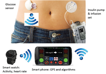 Automated Insulin Delivery System